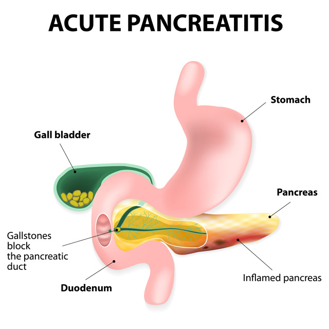Vitamin K3 may reduce inflammation in potentially fatal, painful acute pancreatitis.