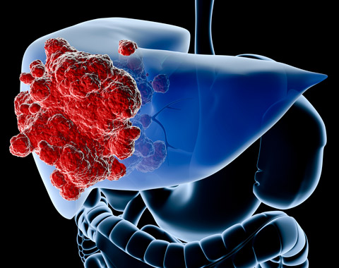 Vitamin K2 shows clinical benefit for liver cancer. Vitamin K could help lower the risk of liver cancer. Vitamin K2 may help prevent and treat liver cancer.