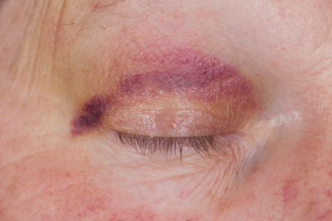 Vitamin K creams and gels are used to treat post-operative bruising.